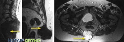 فحوصات الرنين المغناطيسي تظهر الأورام الحبلية